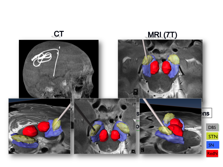 Patient-specific DBS Lead location fusing preoperative 7T MRI and Postoperative CT imaging