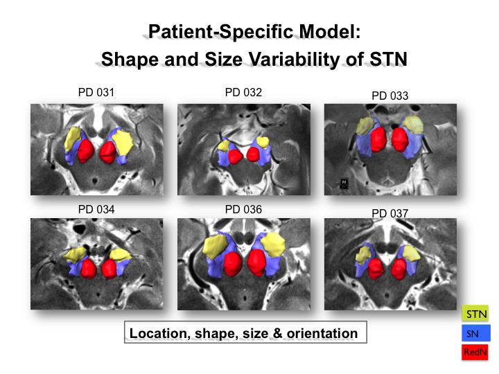 Patient-Specific Model: Shape and Size Variability of STN